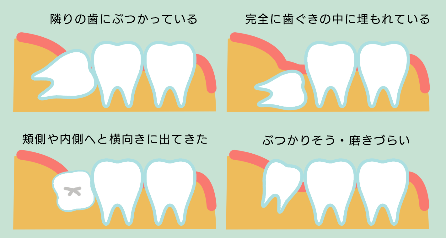 親知らず｜立石たけしま歯科・青戸駅